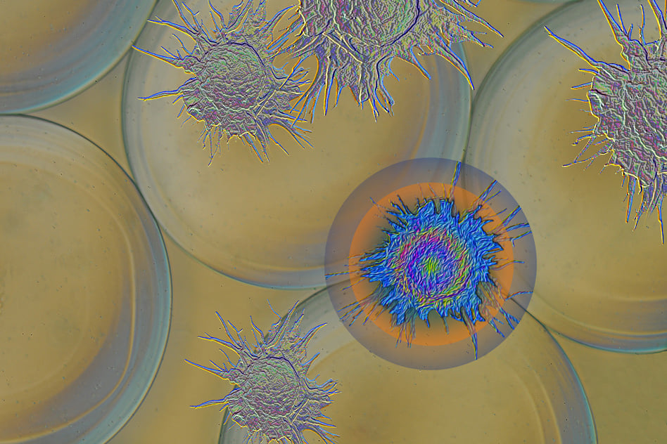 The immune system often builds up a wall of dense scar tissue around implanted medical devices, a process known as fibrosis. The cell shown in blue represents a macrophage that has been blocked from initiating fibrosis.