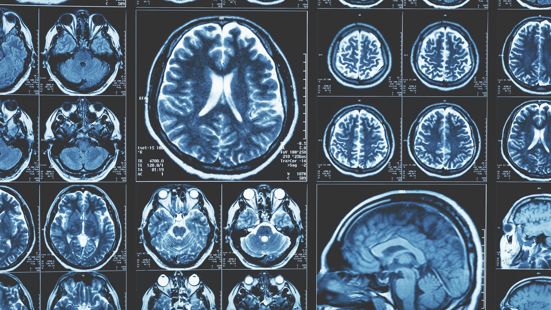 A series of MRI brain scans are shown in the image.