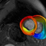 A model of a patient’s heart is constructed from MRI and PET scans.
