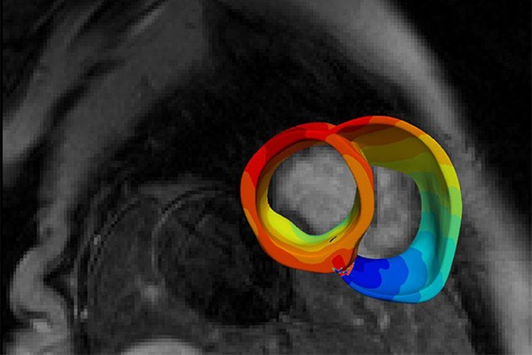 A model of a patient’s heart is constructed from MRI and PET scans.