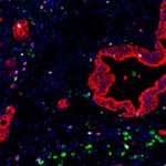 Immune cells called myelomonocytes (green) cluster near pancreatic cancer cells (red).