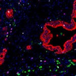 Immune cells called myelomonocytes (green) cluster near pancreatic cancer cells (red).