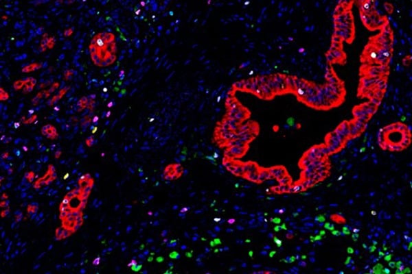 Immune cells called myelomonocytes (green) cluster near pancreatic cancer cells (red).