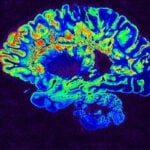 MRI image of a brain