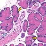 Blue arrows point to normal pancreatic ductal mouse cells. Yellow arrows point to cells undergoing acinar-to-ductal metaplasia. Credit: Johns Hopkins Medicine