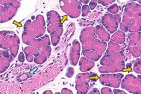 Blue arrows point to normal pancreatic ductal mouse cells. Yellow arrows point to cells undergoing acinar-to-ductal metaplasia. Credit: Johns Hopkins Medicine